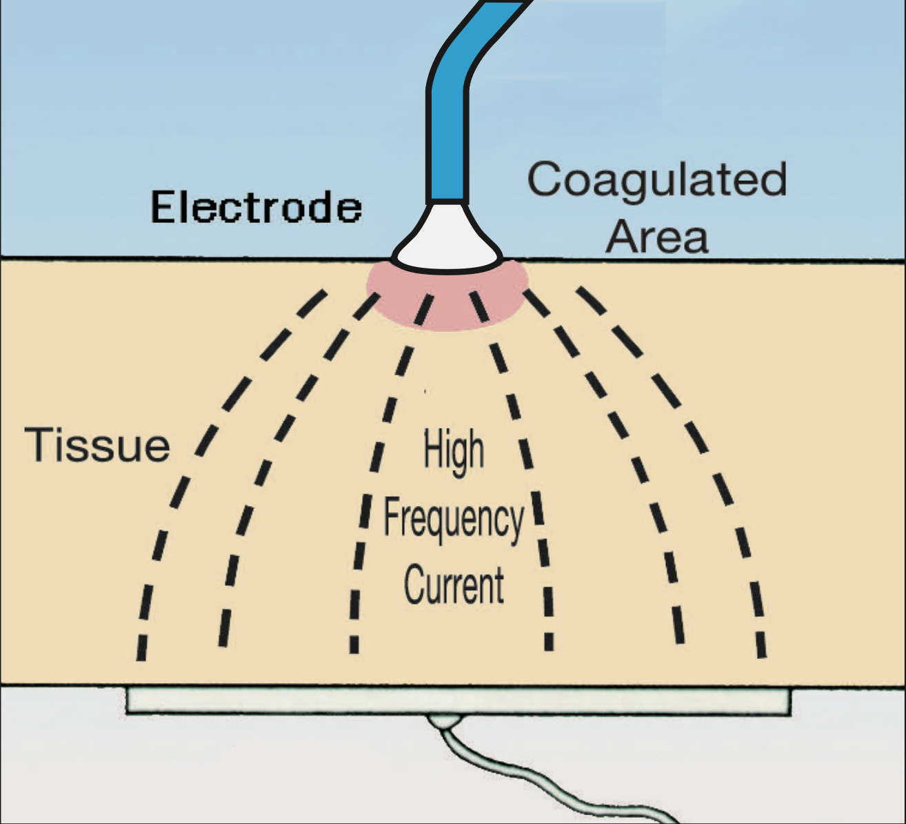 High-frequency current and coagulated tissue — source illustration